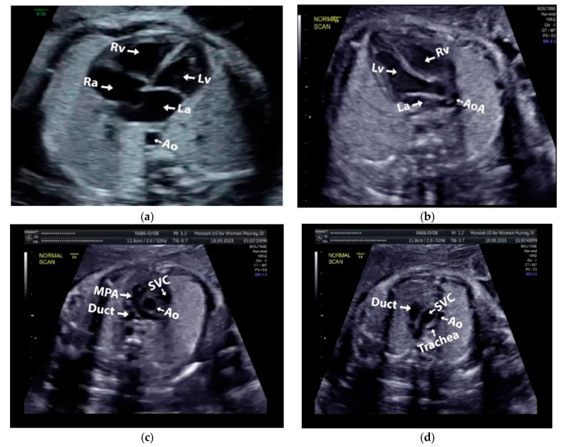 Четыре стандартных проекции сердца плода — 4CH, LVOT, RVOT, 3VT