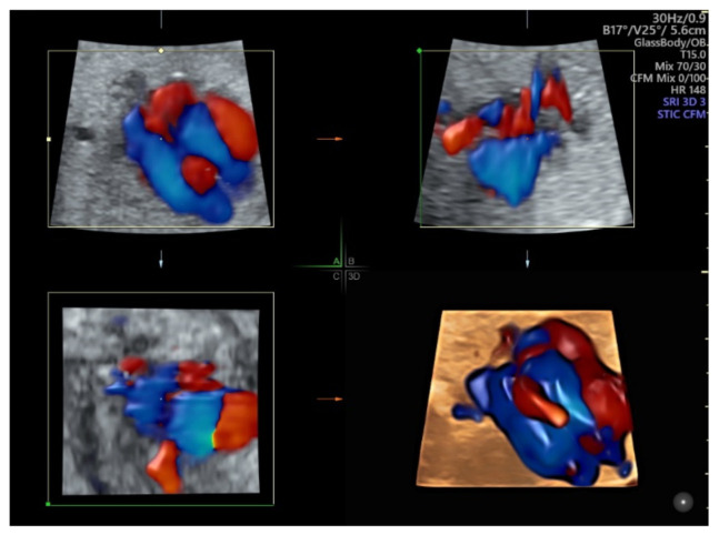 Сердце плода в режиме STIC + Color Doppler glass-body
